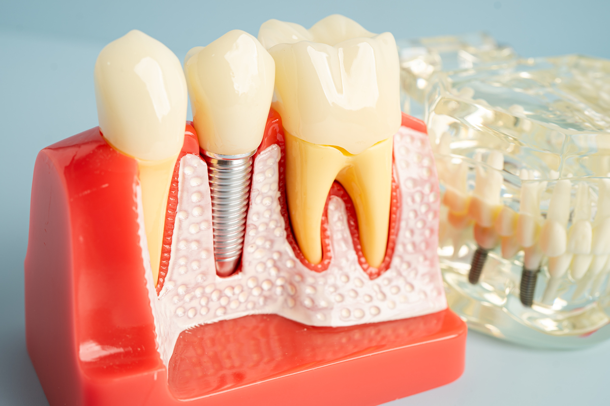 Dental implant model showing artificial tooth and implant structure